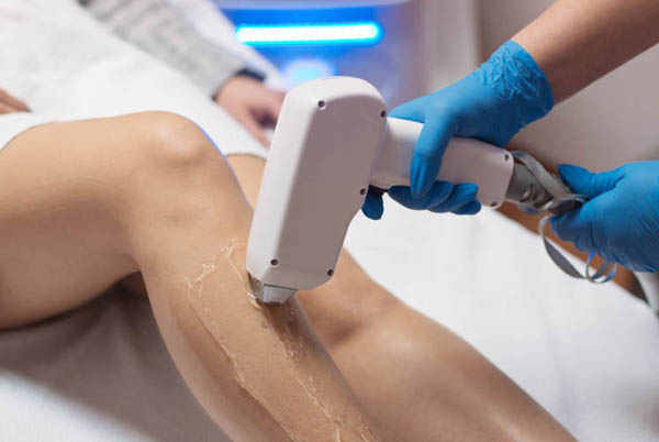 epilazione laser acireale